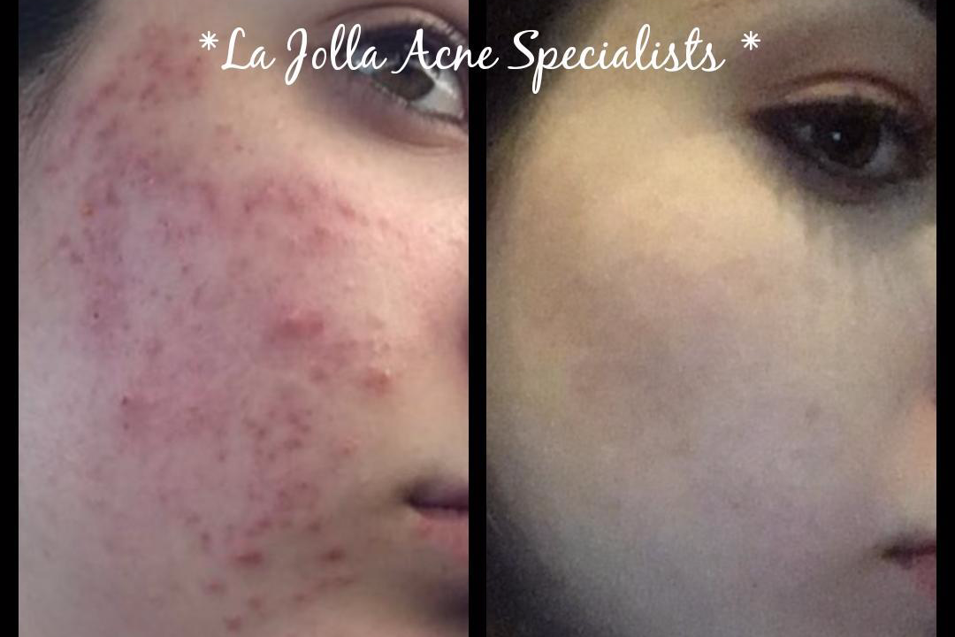 La Jolla Acne Specialists In San Diego Ca Vagaro